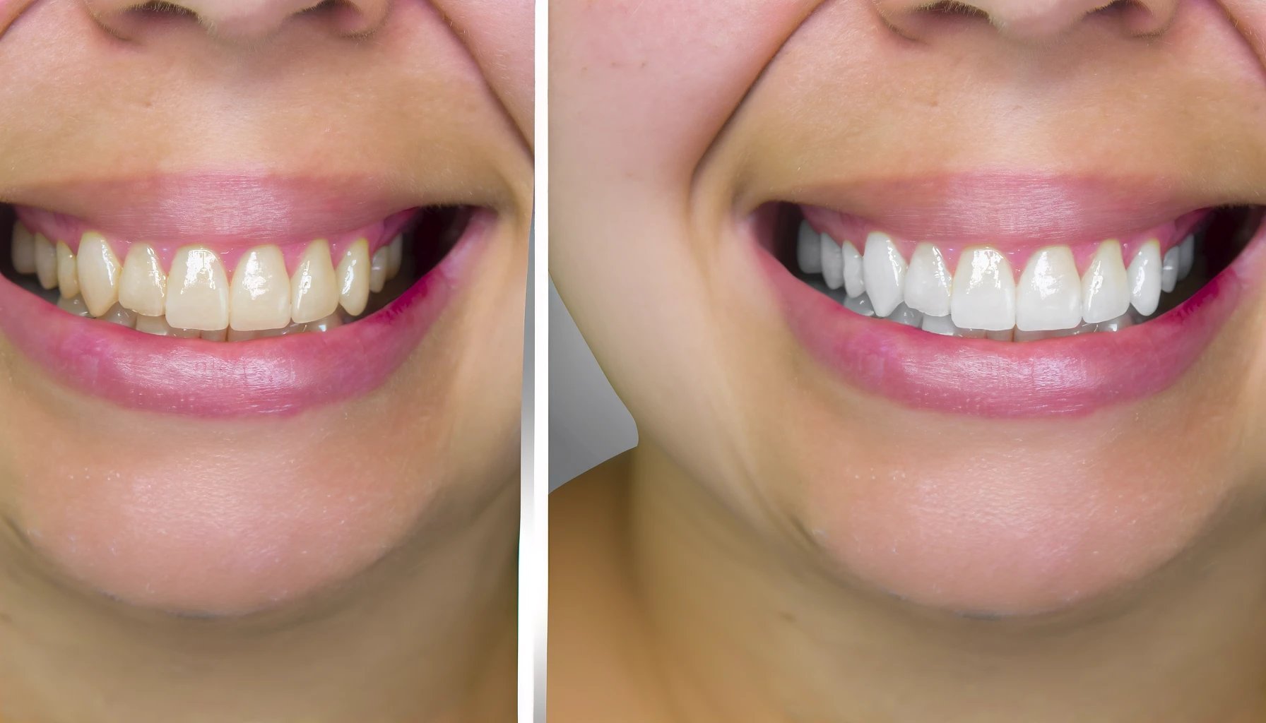 antes y después del blanqueamiento dental
