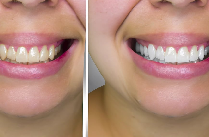 antes y después del blanqueamiento dental