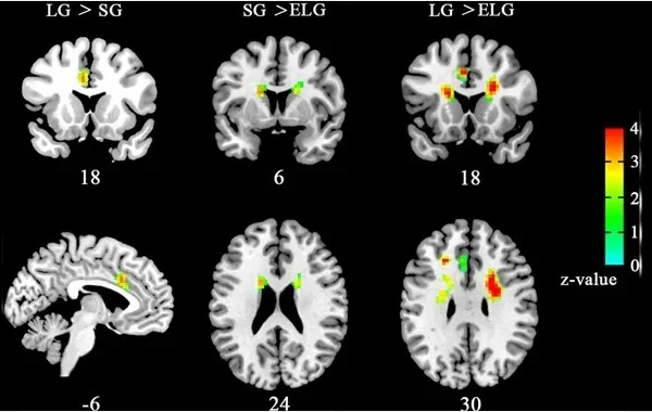 Así se ve un cerebro enamorado